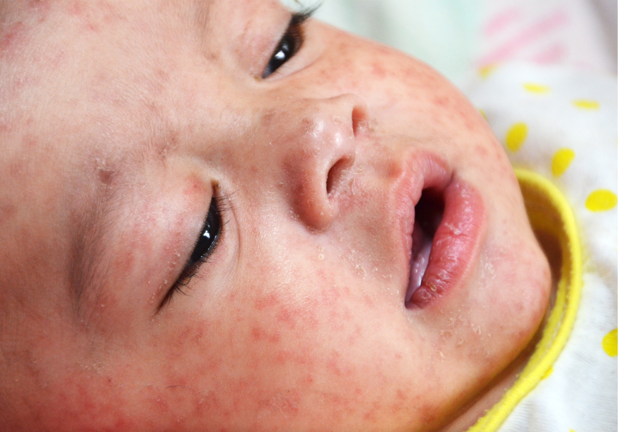 a child with a skin rash on face from measles